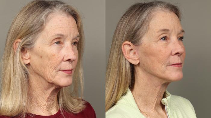 Before & After Facelift Case 447 Right Oblique View in Gilbert, AZ