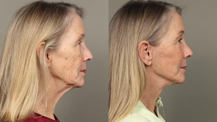 Before & After Facelift Case 447 Right Side View in Gilbert, AZ