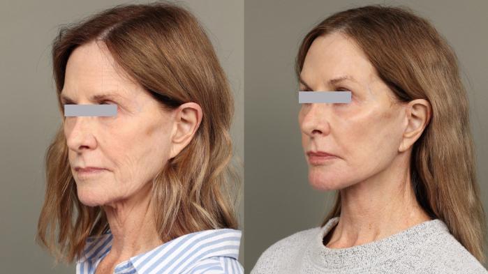 Before & After Facelift Case 448 Left Oblique View in Gilbert, AZ