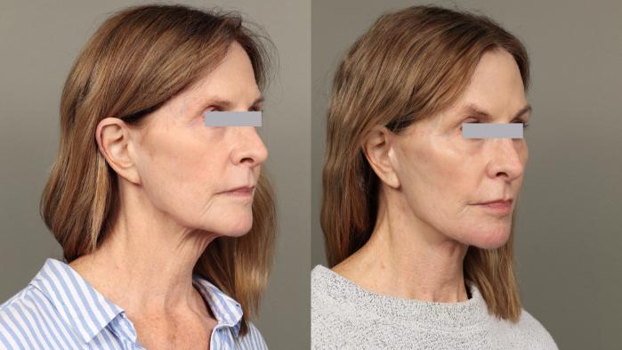 Before & After Facelift Case 448 Right Oblique View in Gilbert, AZ