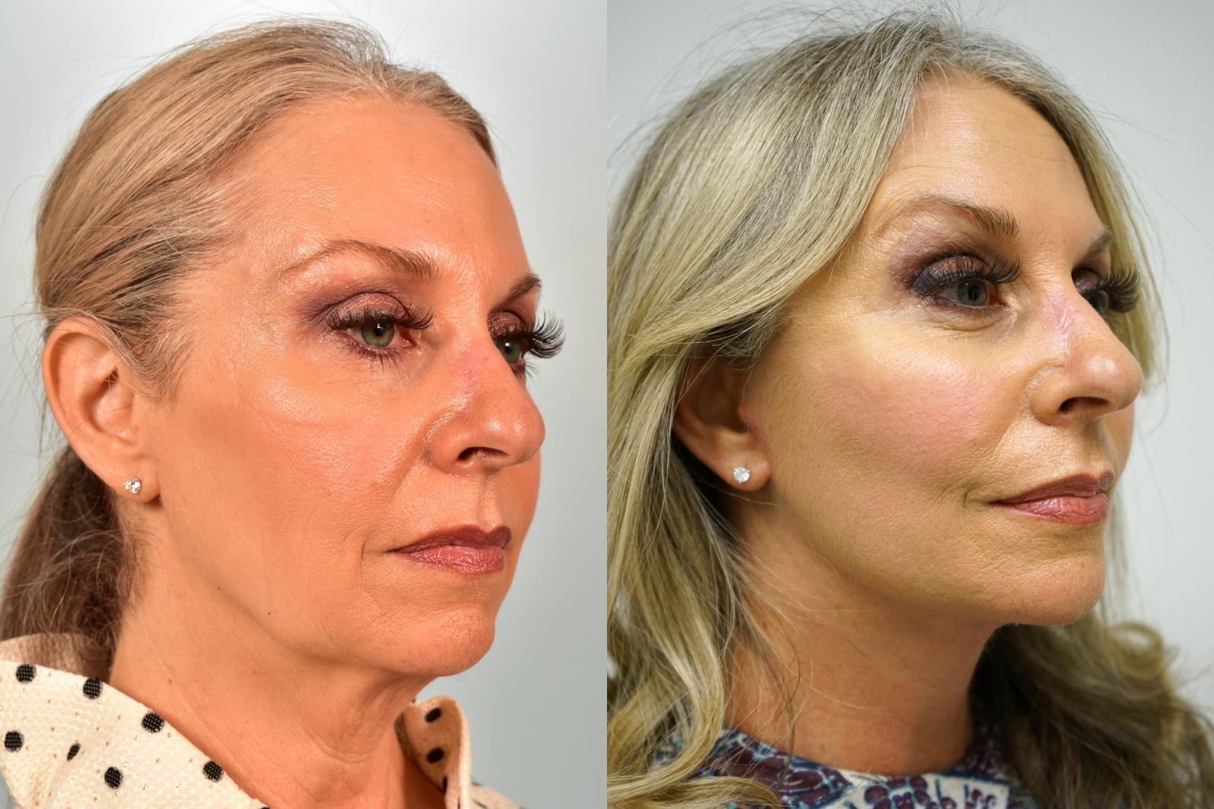 Before & After Facelift Case 454 Right Oblique View in Gilbert, AZ