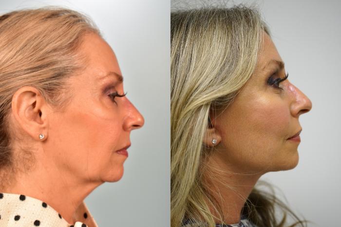 Before & After Facelift Case 454 Right Side View in Gilbert, AZ