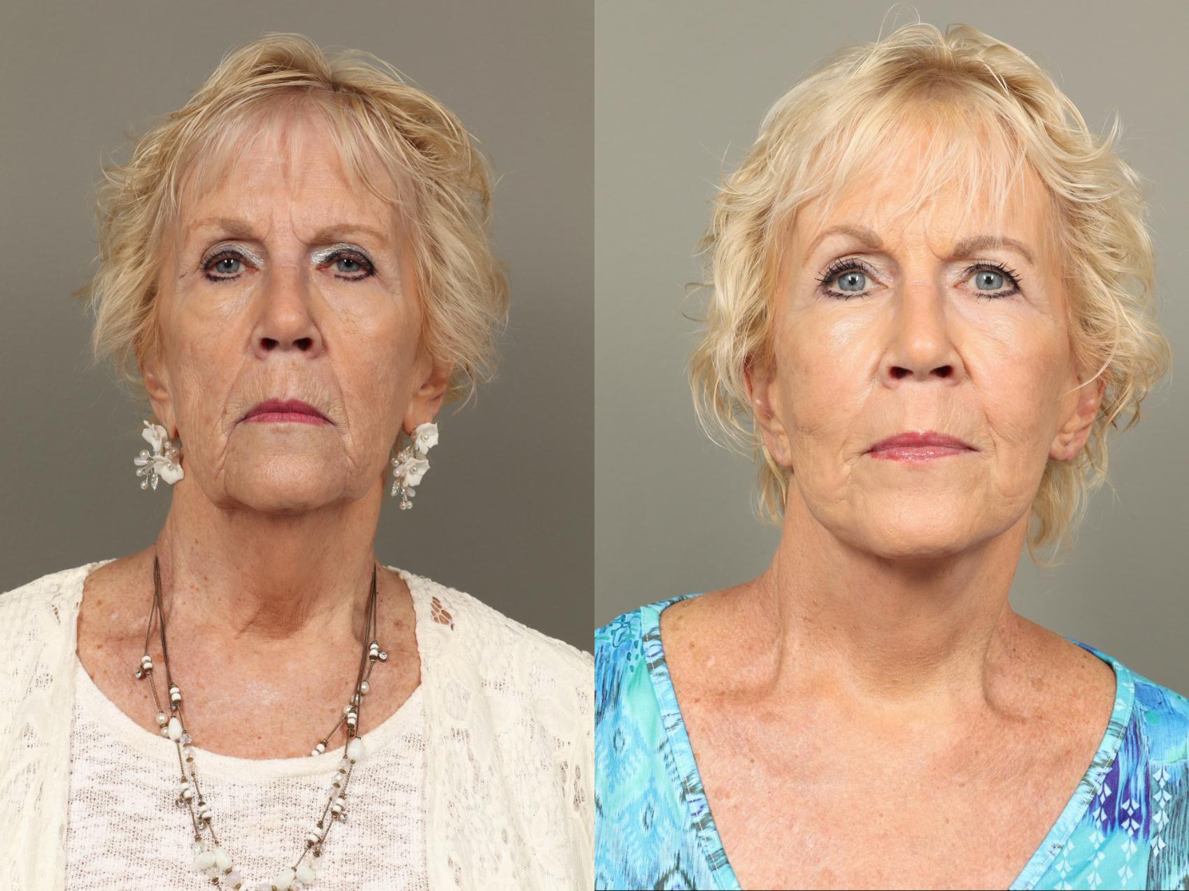 Before & After Facelift Case 477 Front View in Gilbert, AZ