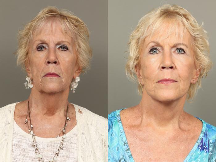 Before & After Facelift Case 477 Front View in Gilbert, AZ