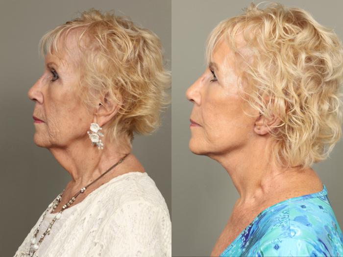 Before & After Facelift Case 477 Left Side View in Gilbert, AZ
