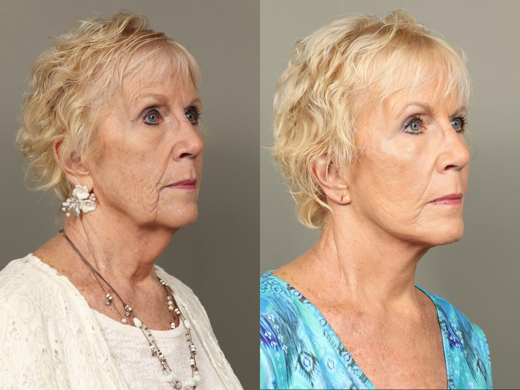 Before & After Facelift Case 477 Right Oblique View in Gilbert, AZ
