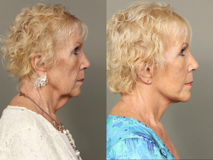 Before & After Facelift Case 477 Right Side View in Gilbert, AZ