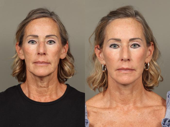 Before & After Facelift Case 489 Front View in Gilbert, AZ