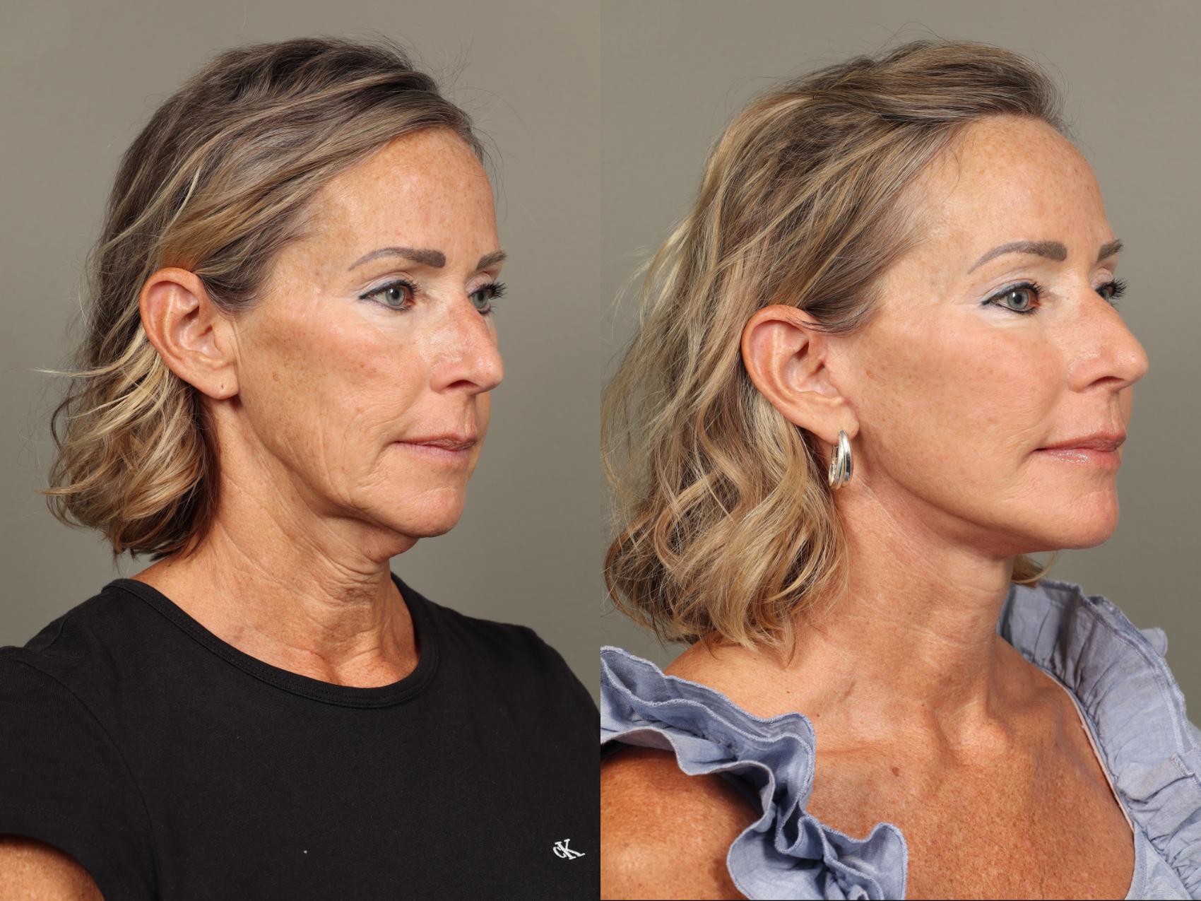 Before & After Facelift Case 489 Left Oblique View in Gilbert, AZ