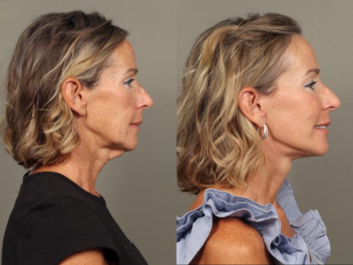 Before & After Facelift Case 489 Left Side View in Gilbert, AZ