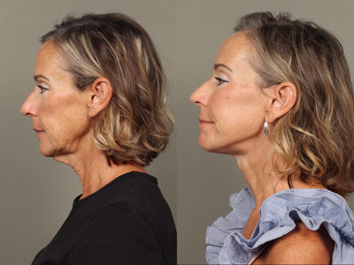 Before & After Facelift Case 489 Right Side View in Gilbert, AZ