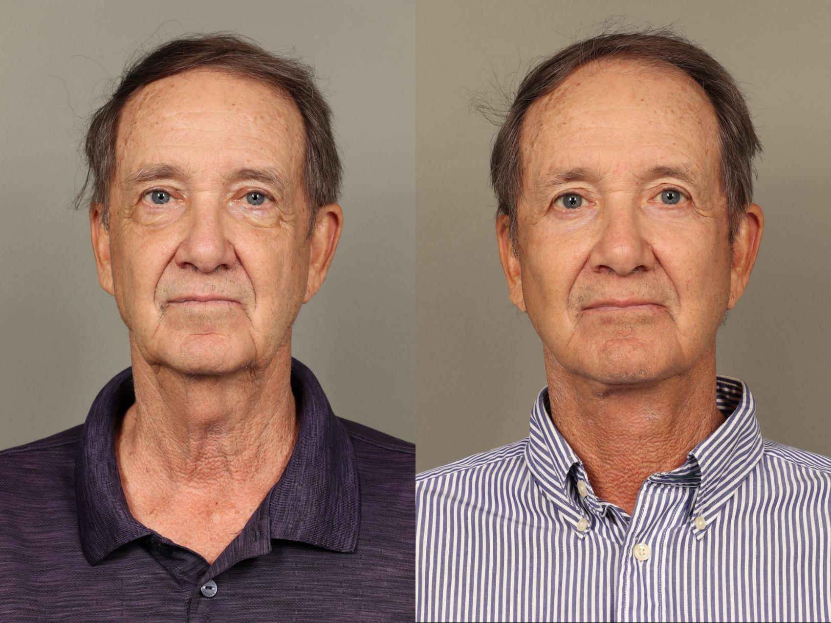 Before & After Facelift Case 504 Front View in Gilbert, AZ
