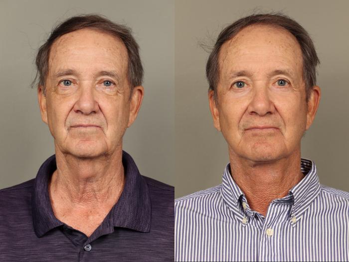 Before & After Facelift Case 504 Front View in Gilbert, AZ