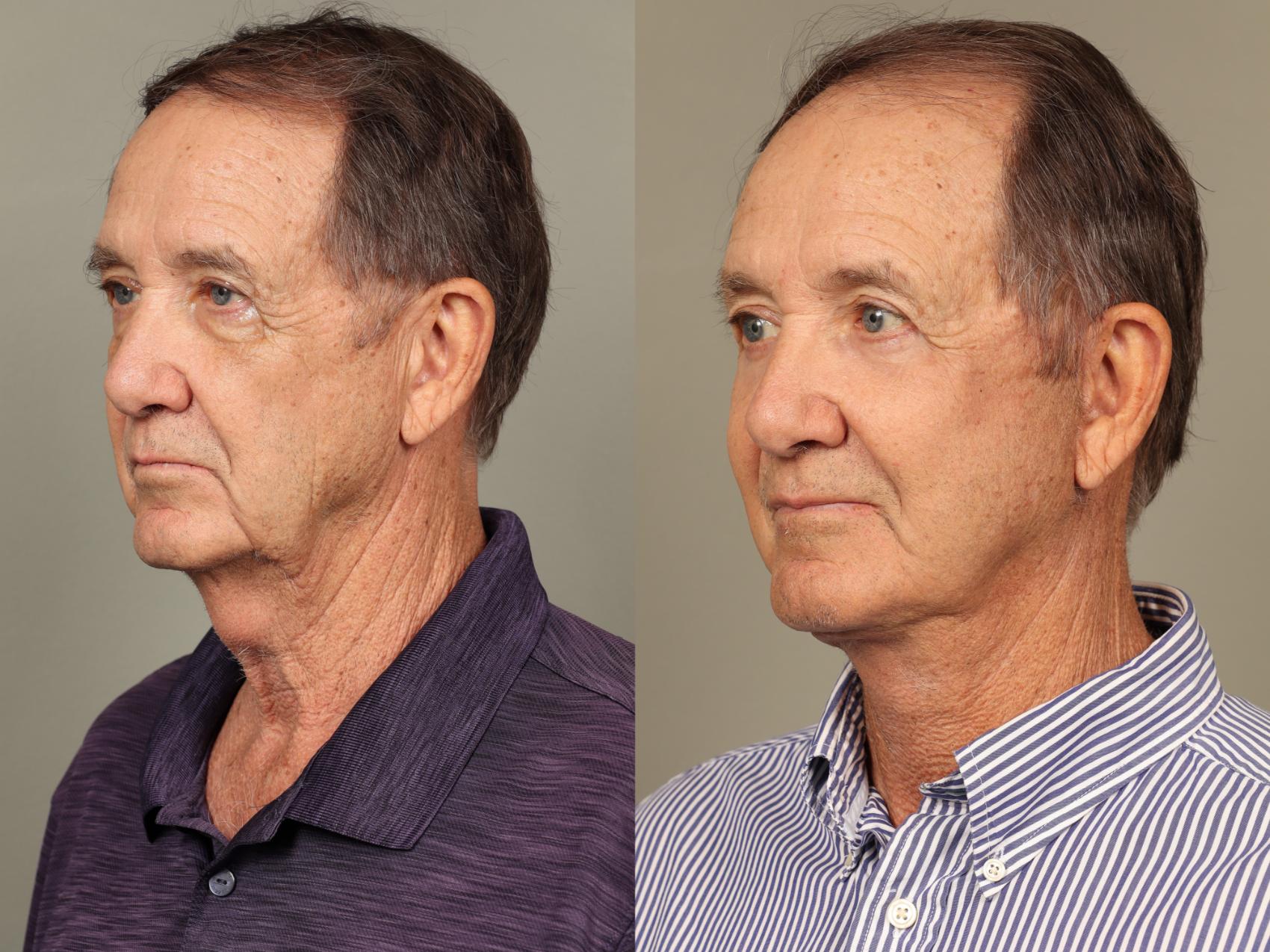 Before & After Facelift Case 504 Left Oblique View in Gilbert, AZ