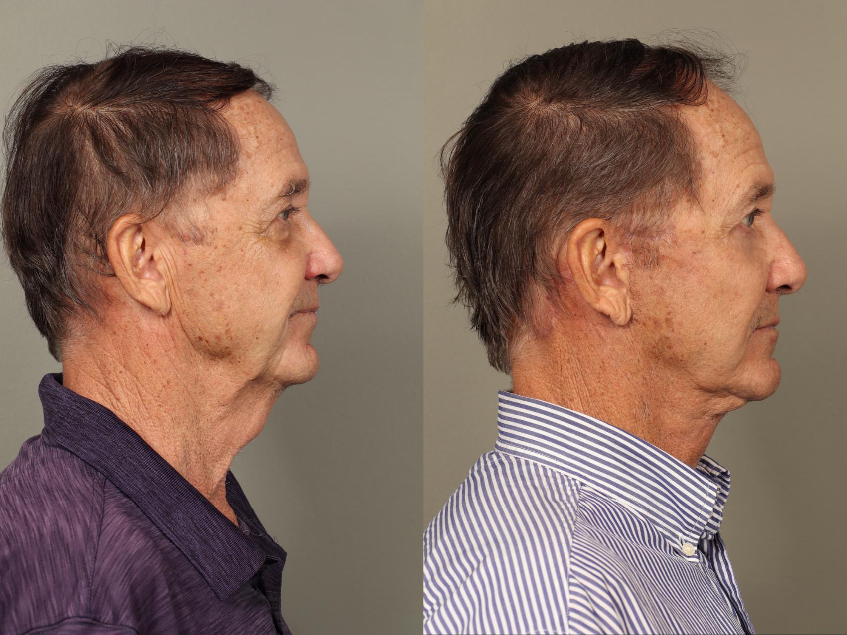 Before & After Facelift Case 504 Left Side View in Gilbert, AZ