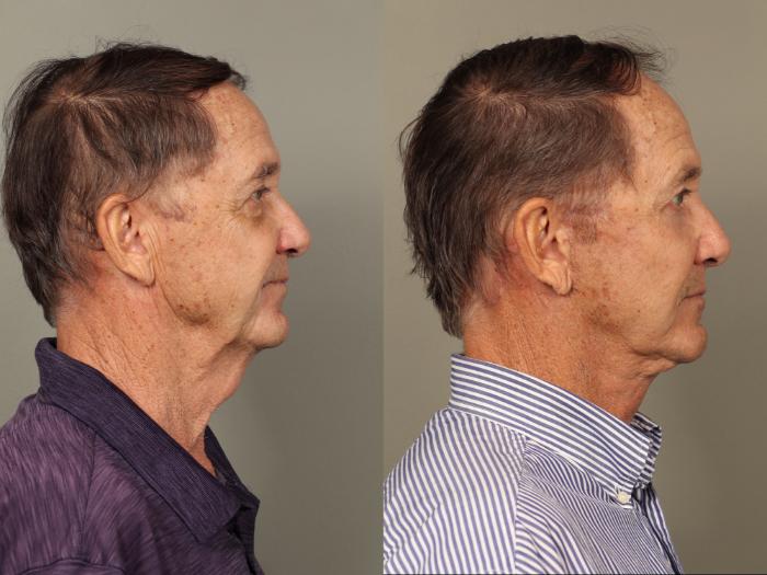 Before & After Facelift Case 504 Left Side View in Gilbert, AZ