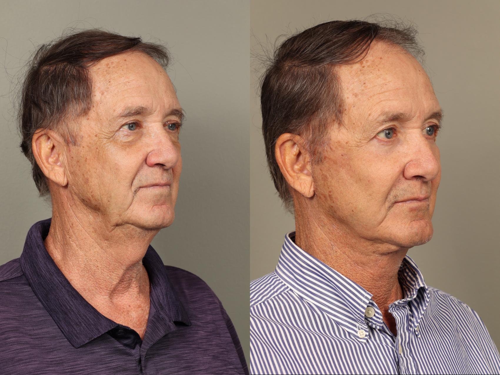 Before & After Facelift Case 504 Right Oblique View in Gilbert, AZ