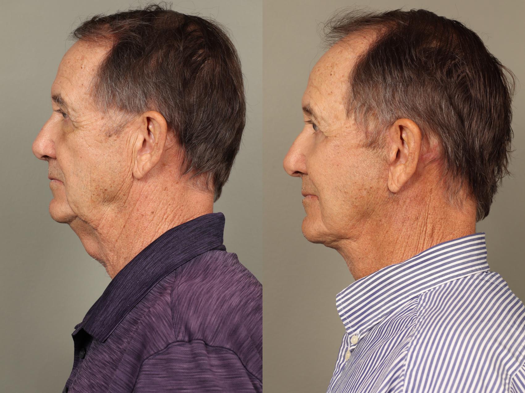 Before & After Facelift Case 504 Right Side View in Gilbert, AZ