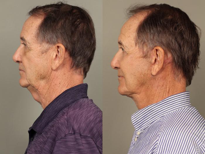 Before & After Facelift Case 504 Right Side View in Gilbert, AZ
