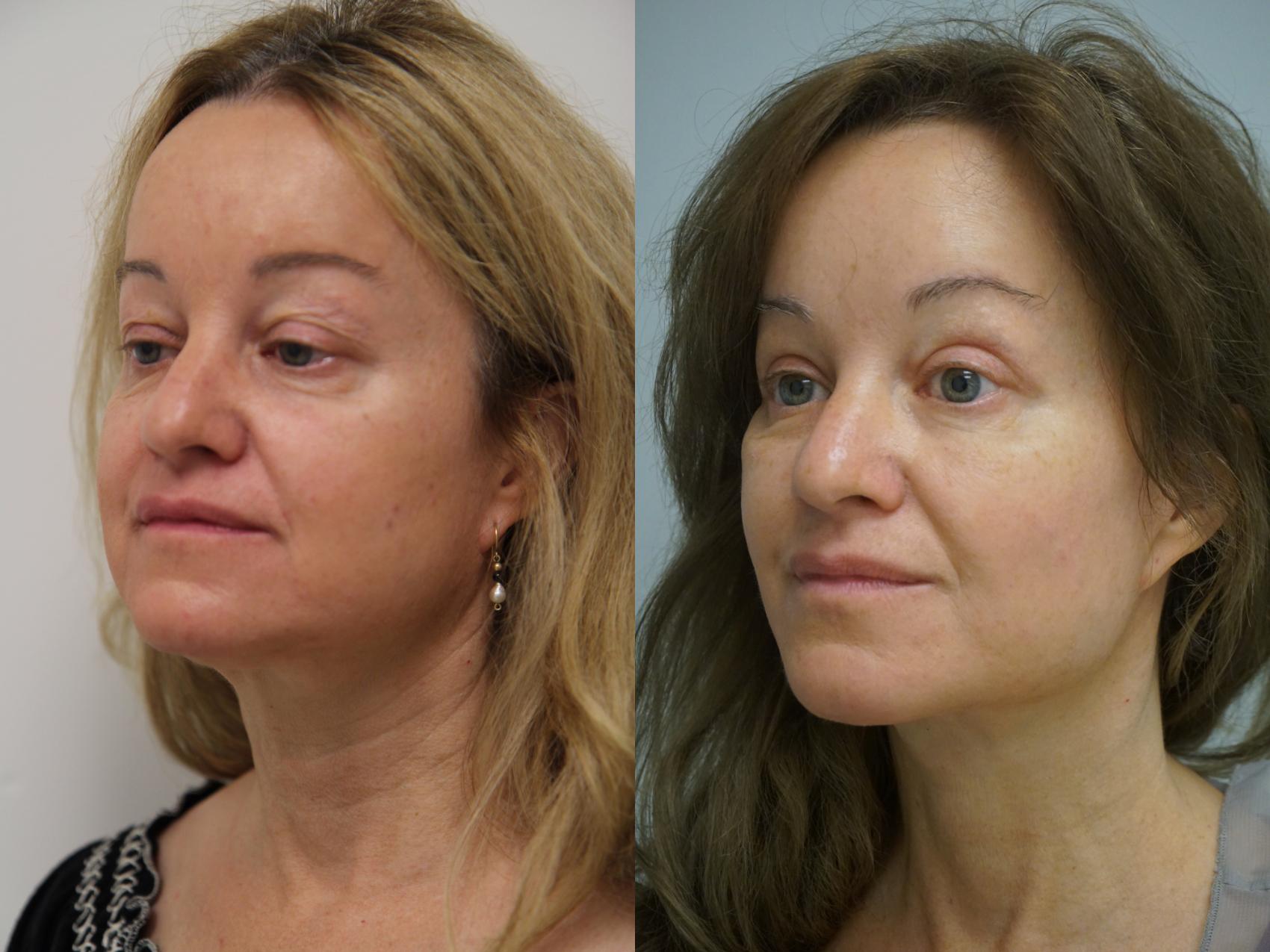 Before & After Facelift Case 96 View #1 View in Gilbert, AZ