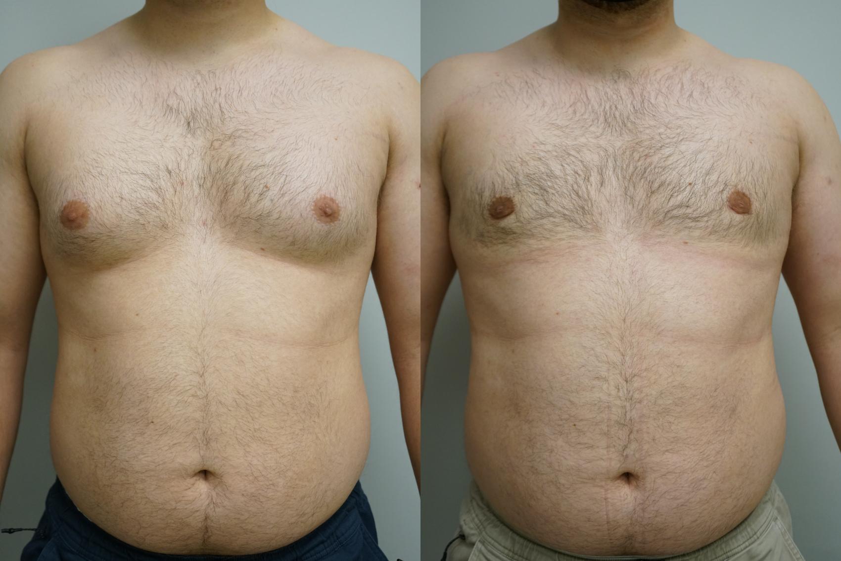 Gynecomastia Before & After Photo Gallery | Gilbert, AZ | Dr. Josh Olson:  Advanced Plastic Surgery Institute