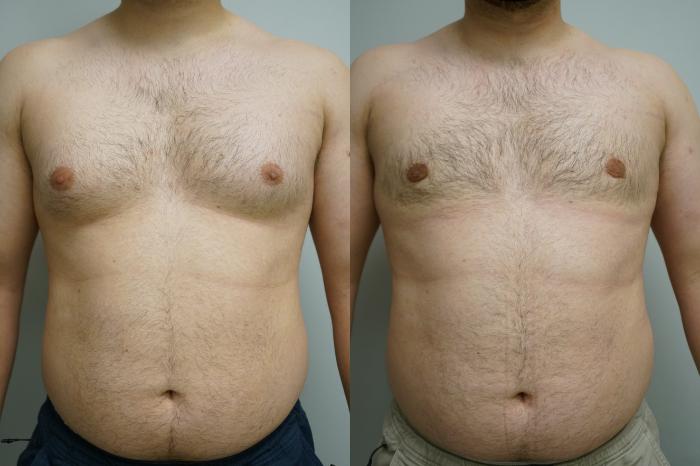 Before & After Gynecomastia Case 368 Front View in Gilbert, AZ