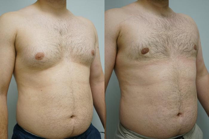 Before & After Gynecomastia Case 368 Right Oblique View in Gilbert, AZ