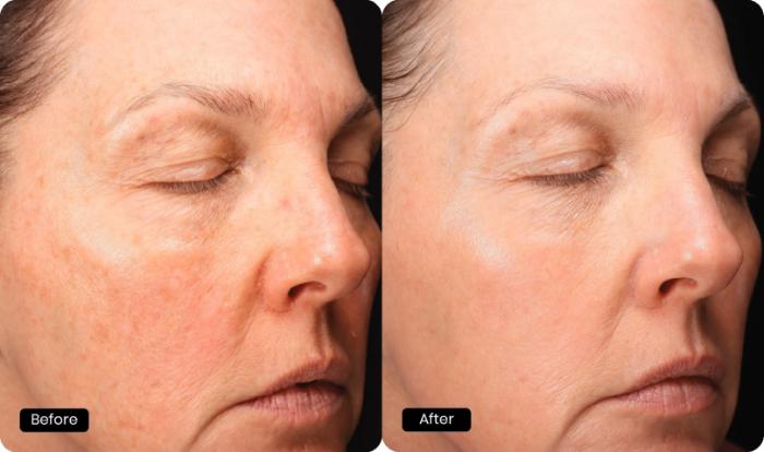 Before & After Halo Tribrid Case 509 Right Oblique View in Gilbert, AZ