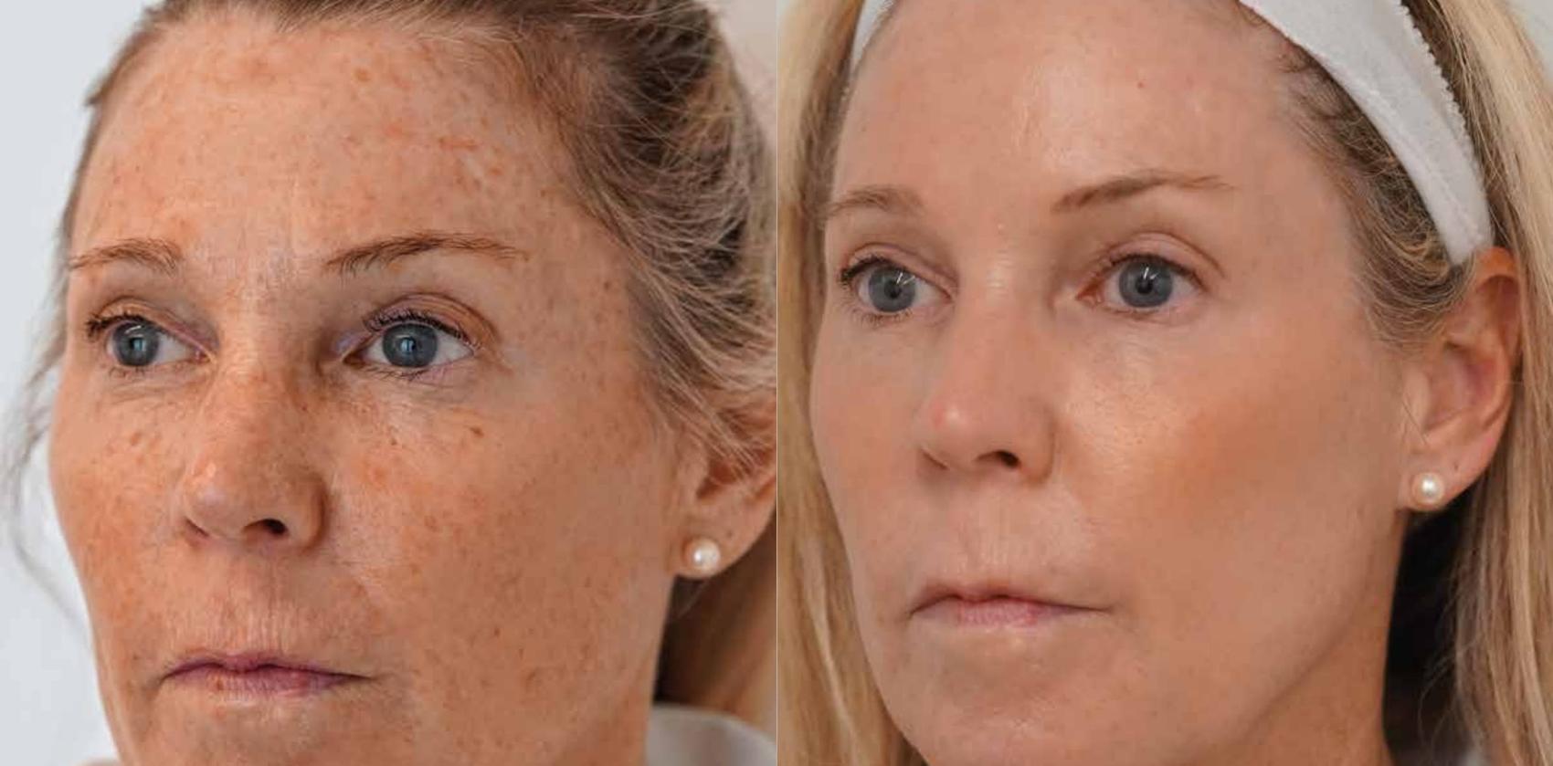 Before & After Halo Tribrid Case 512 Left Oblique View in Gilbert, AZ