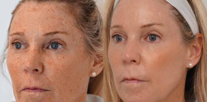 Before & After Halo Tribrid Case 512 Left Oblique View in Gilbert, AZ