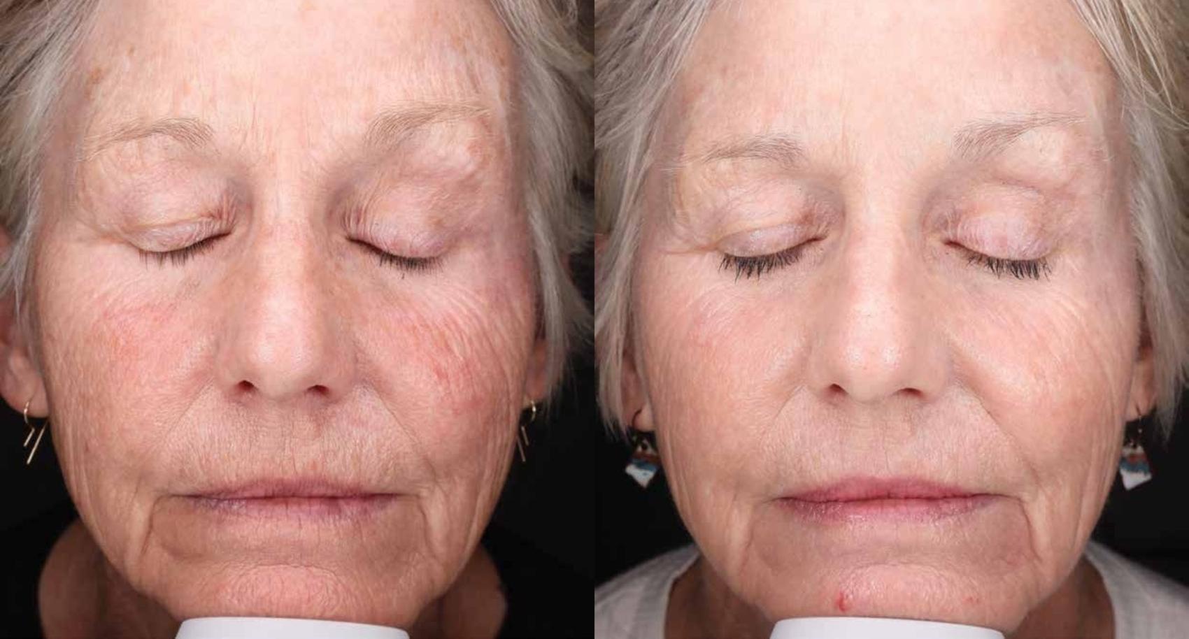 Before & After Halo Tribrid Case 513 Front View in Gilbert, AZ