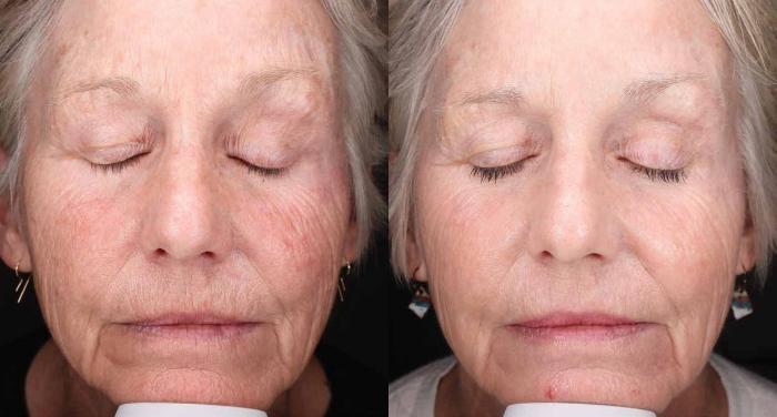 Before & After Halo Tribrid Case 513 Front View in Gilbert, AZ