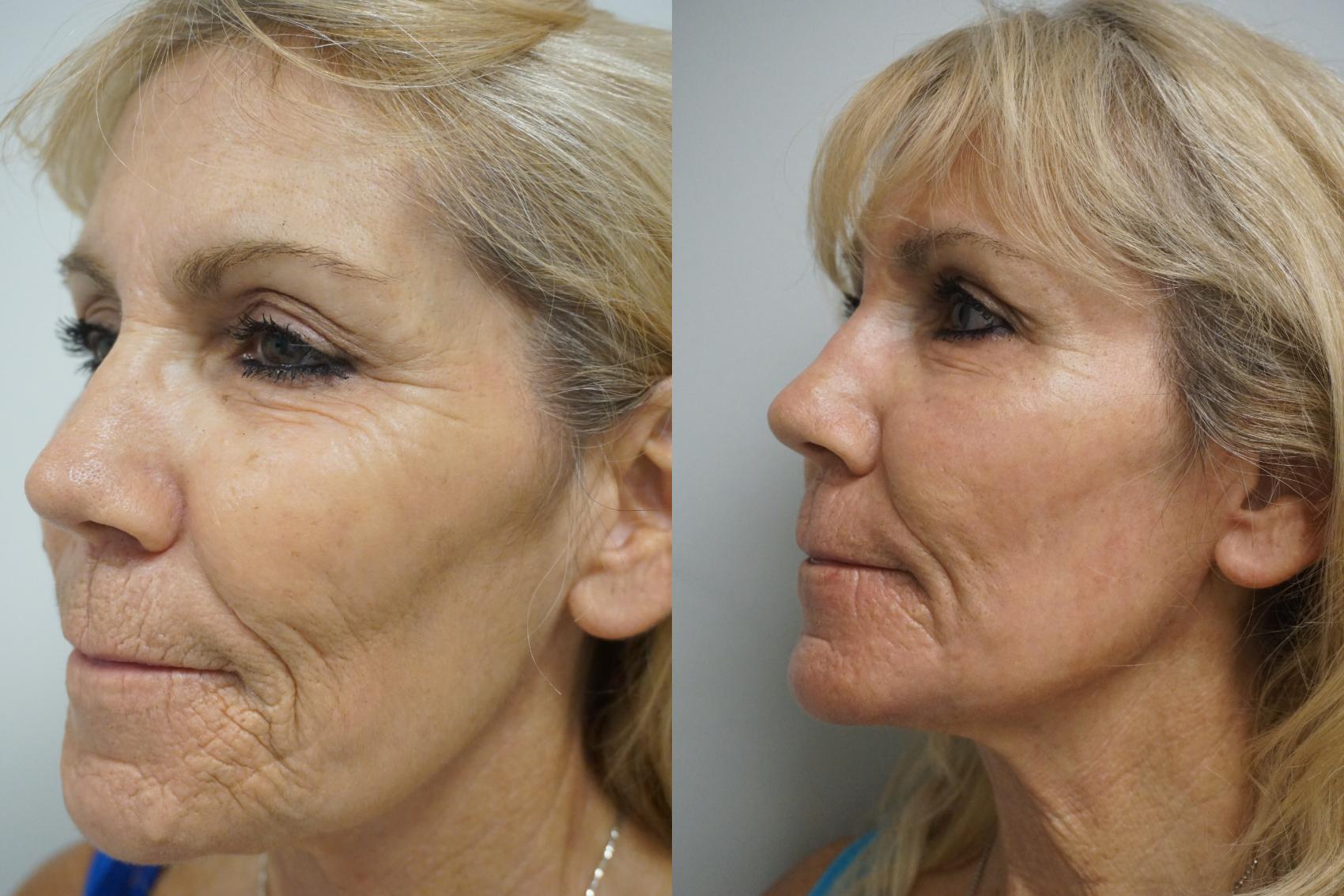 Before & After Laser Skin Resurfacing  Case 300 Left Side View in Gilbert, AZ