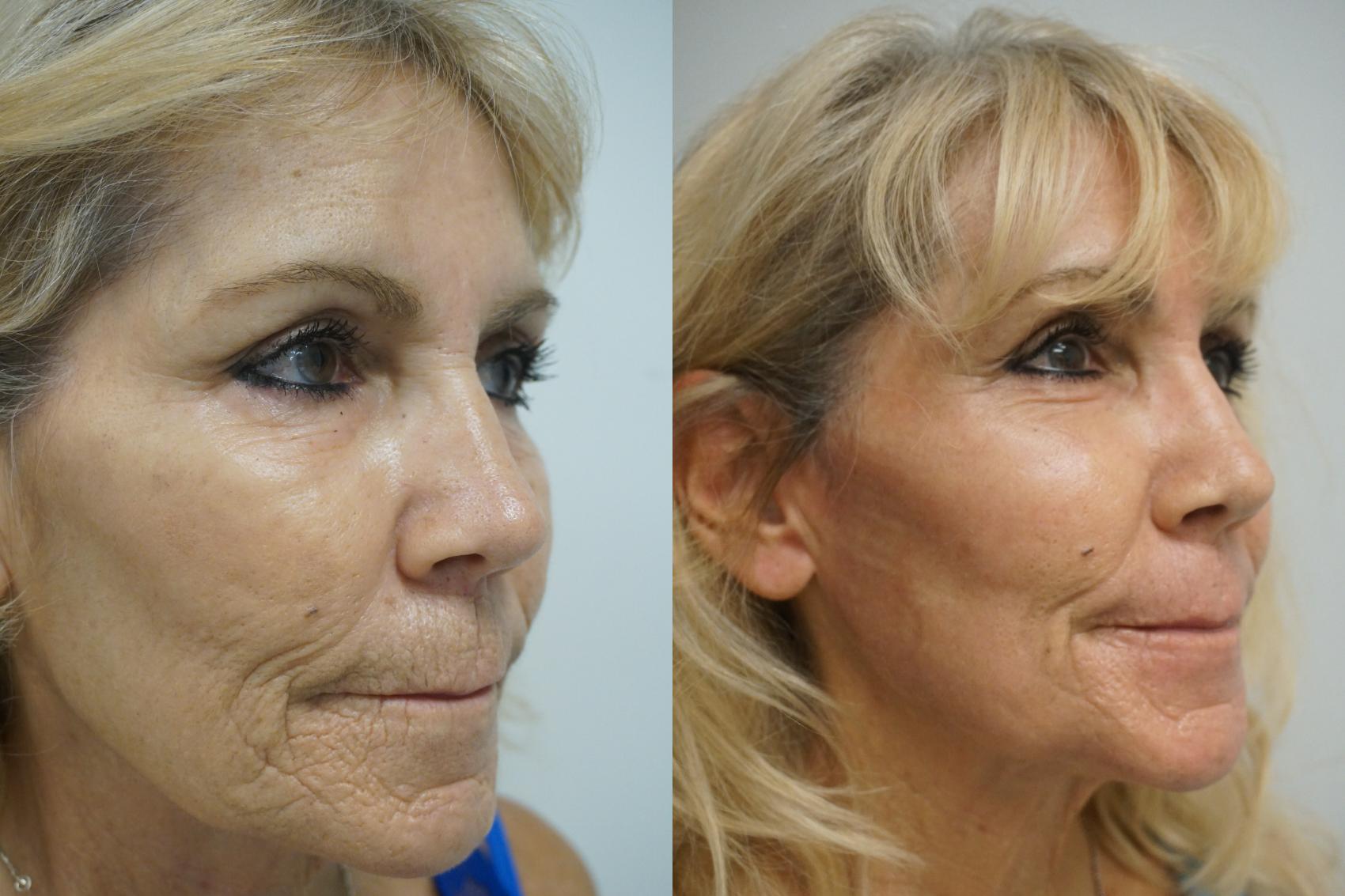 Before & After Laser Skin Resurfacing  Case 300 Right Side View in Gilbert, AZ