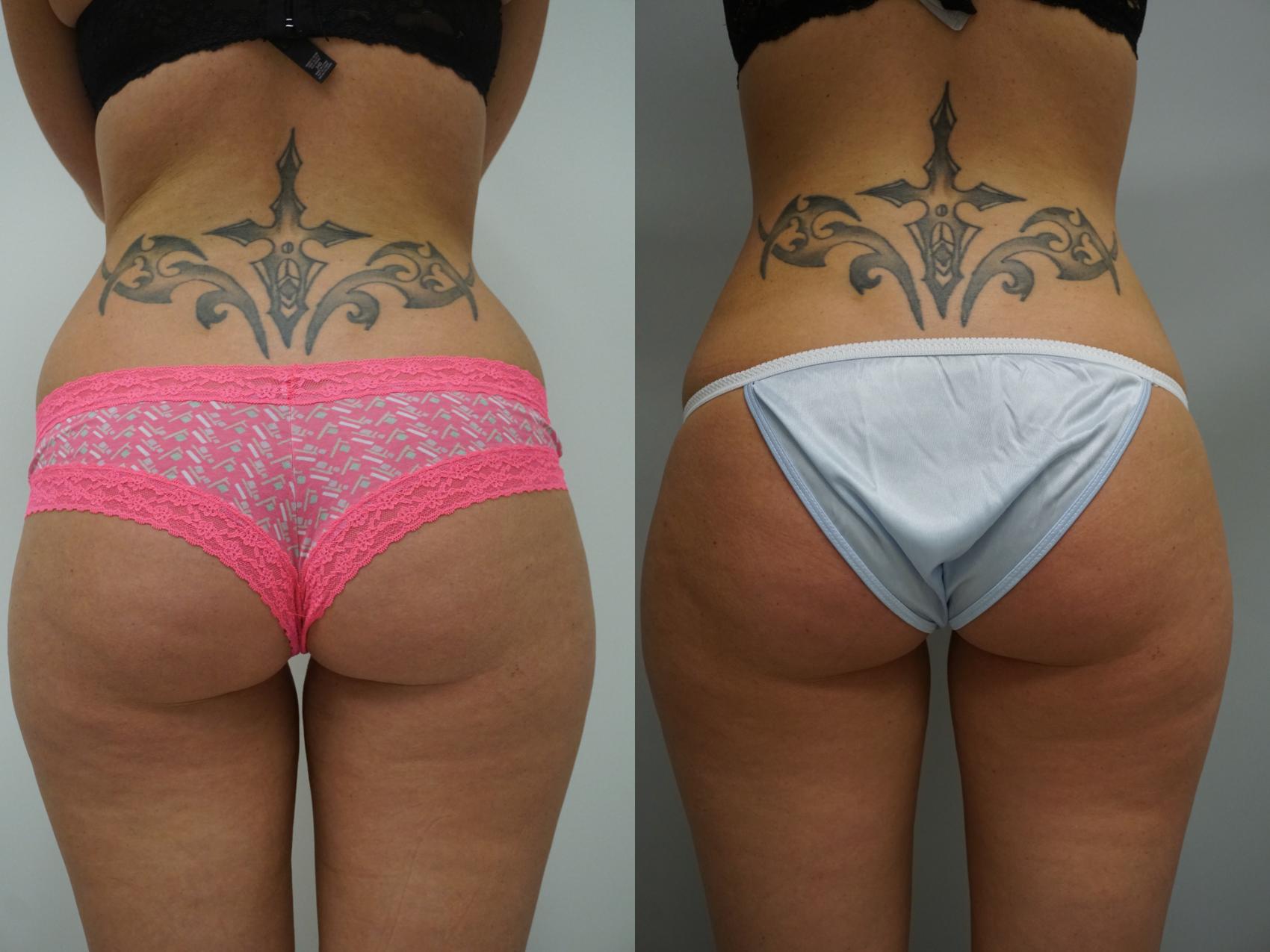 Brazilian Buttock Lift Before and After Pictures Case 296, Gilbert, AZ