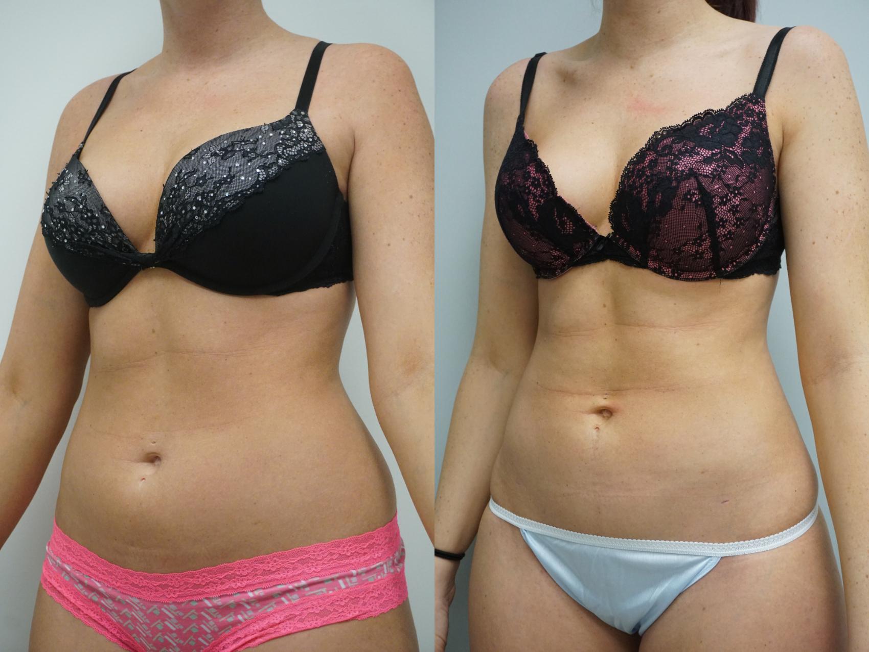 Before & After Liposuction Case 101 View #2 View in Gilbert, AZ