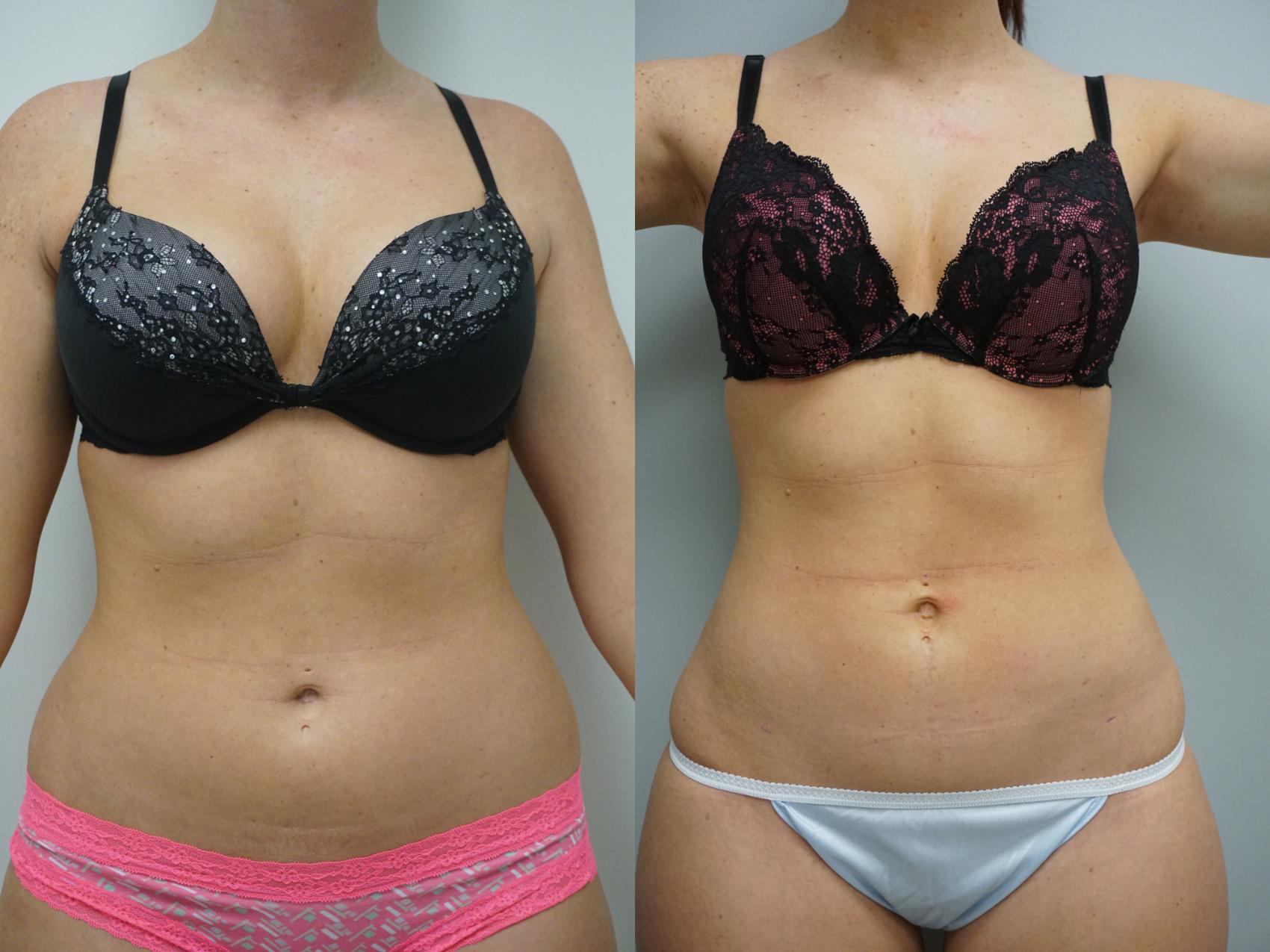 Before & After Liposuction Case 101 View #3 View in Gilbert, AZ