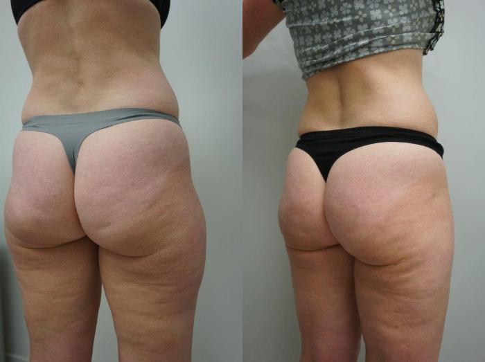 Before & After Liposuction Case 143 View #1 View in Gilbert, AZ