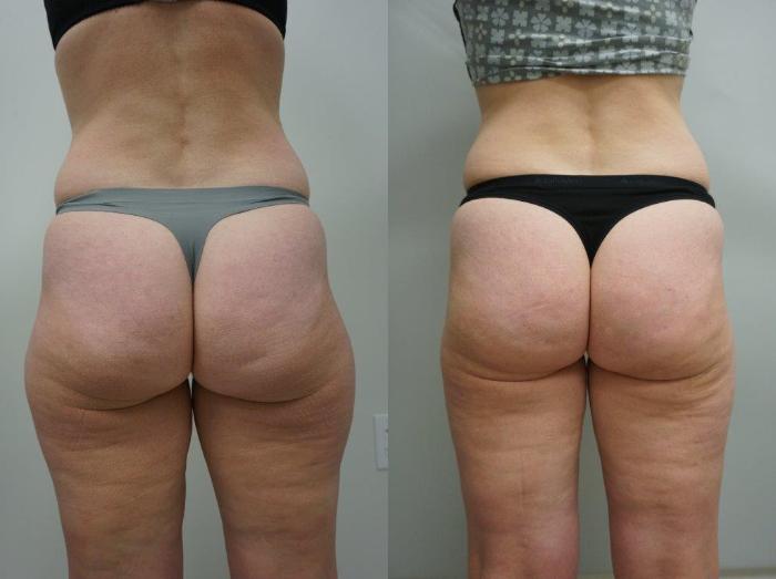Before & After Liposuction Case 143 View #2 View in Gilbert, AZ