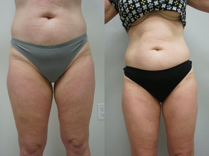 Before & After Liposuction Case 143 View #3 View in Gilbert, AZ