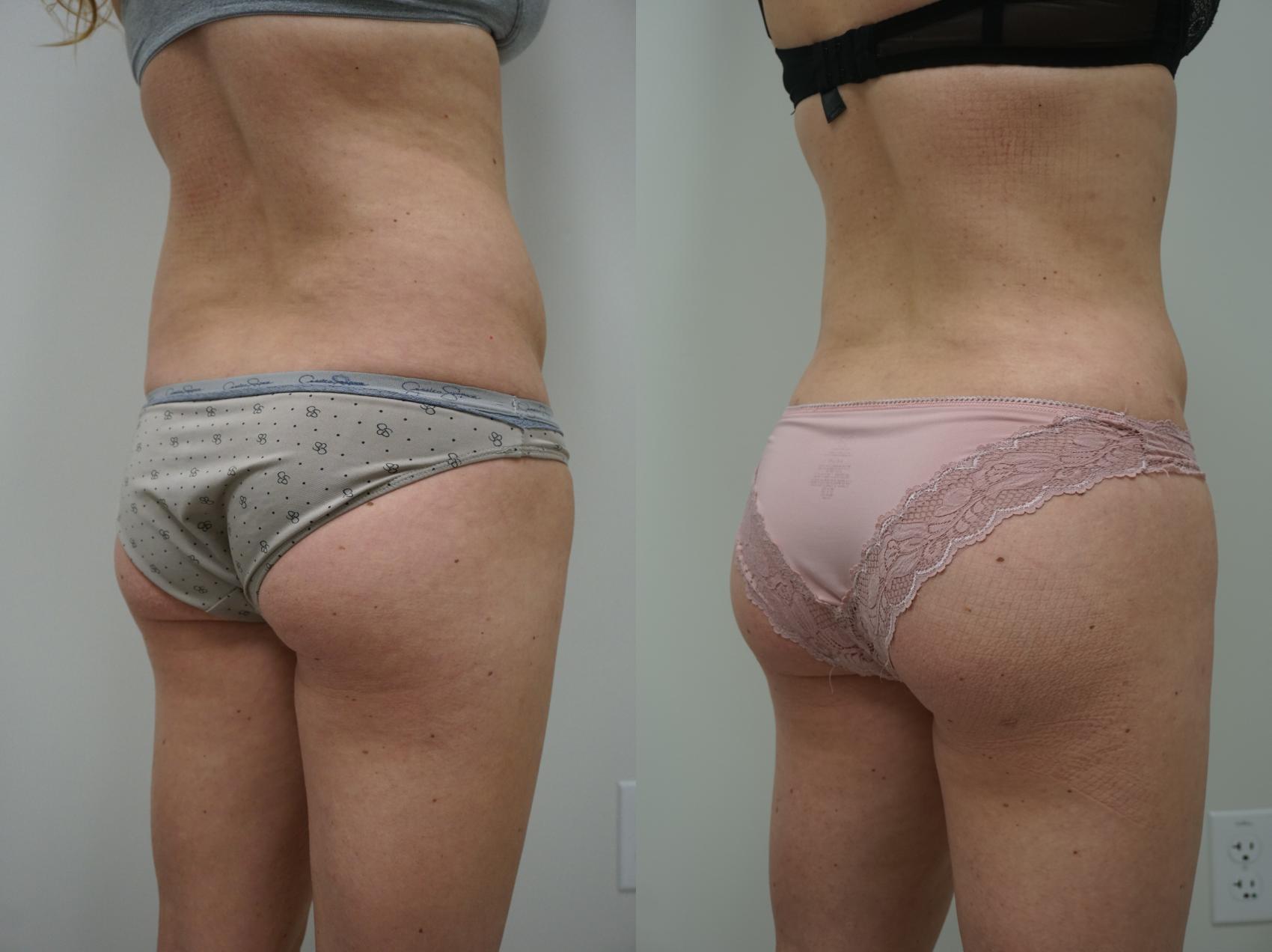 Before & After Liposuction Case 146 View #1 View in Gilbert, AZ