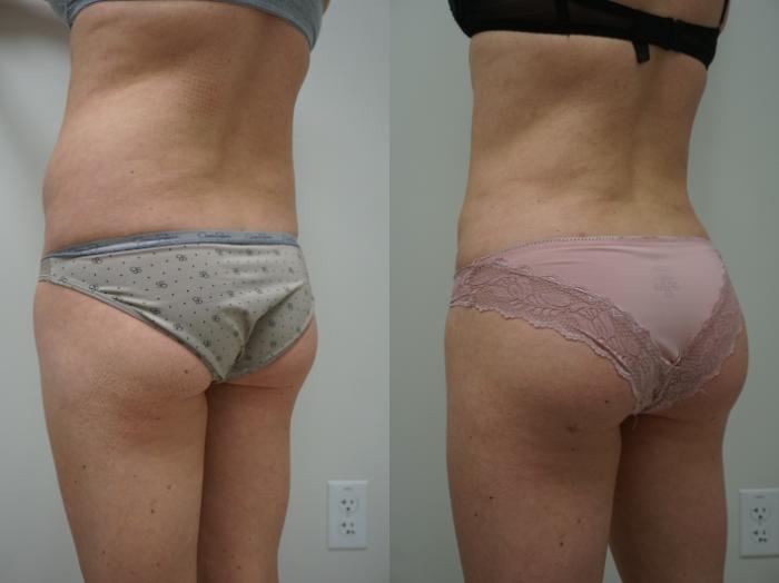 Before & After Liposuction Case 146 View #2 View in Gilbert, AZ