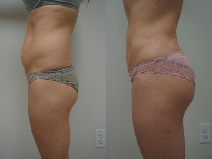 Before & After Liposuction Case 146 View #3 View in Gilbert, AZ