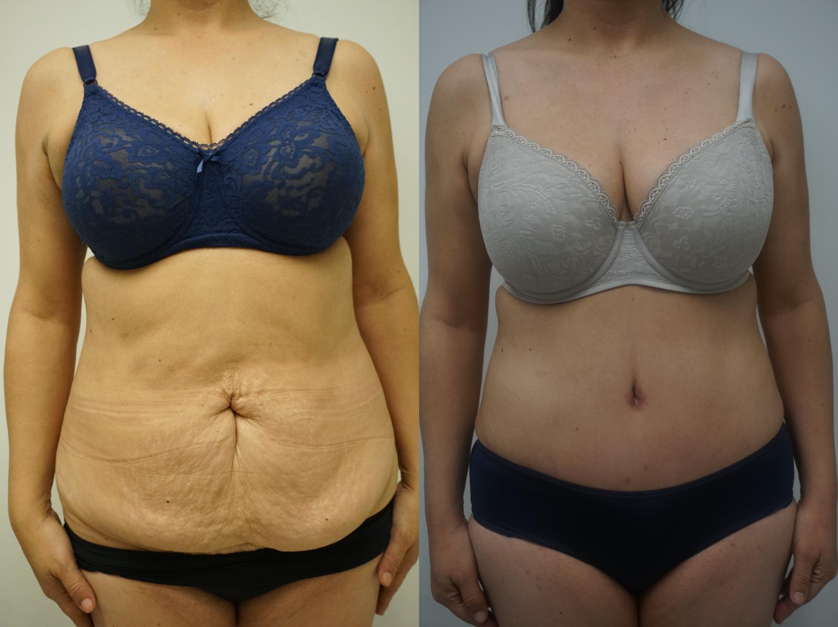 Before & After Liposuction Case 149 View #1 View in Gilbert, AZ