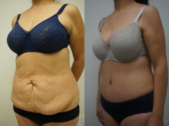 Before & After Liposuction Case 149 View #2 View in Gilbert, AZ