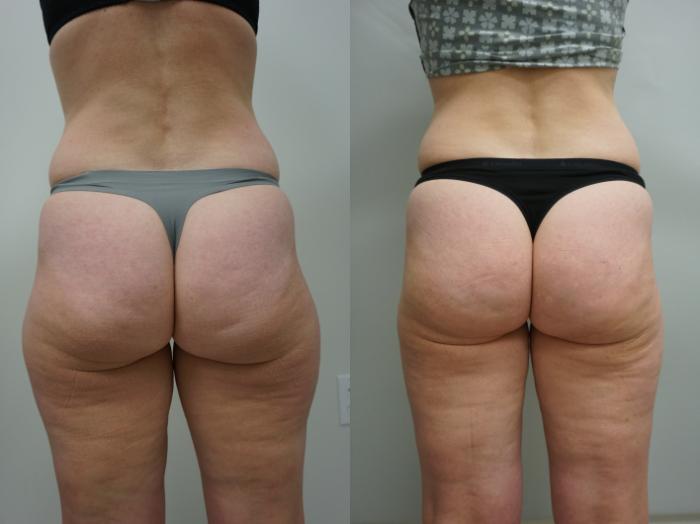 Before & After Liposuction Case 187 View #2 View in Gilbert, AZ