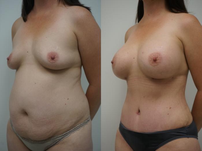 Before & After Liposuction Case 202 View #1 View in Gilbert, AZ