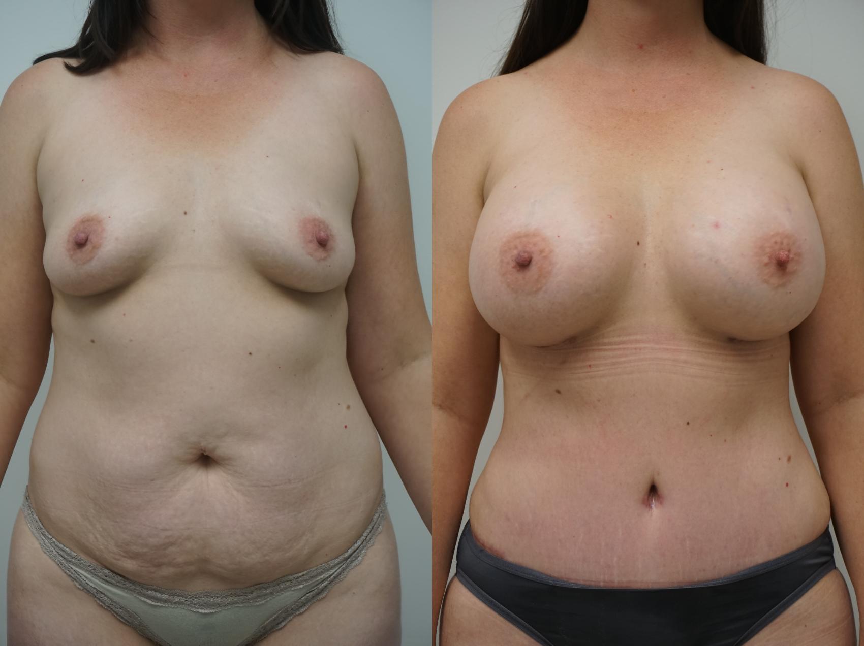 Before & After Liposuction Case 202 View #2 View in Gilbert, AZ