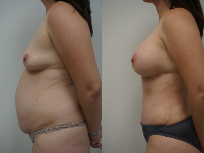 Before & After Liposuction Case 202 View #3 View in Gilbert, AZ