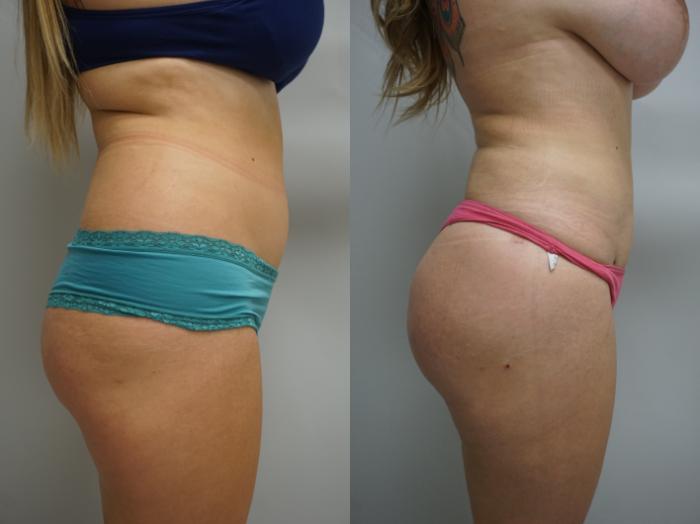 Before & After Liposuction Case 204 View #1 View in Gilbert, AZ